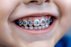 Closeup of a child's teeth with braces
